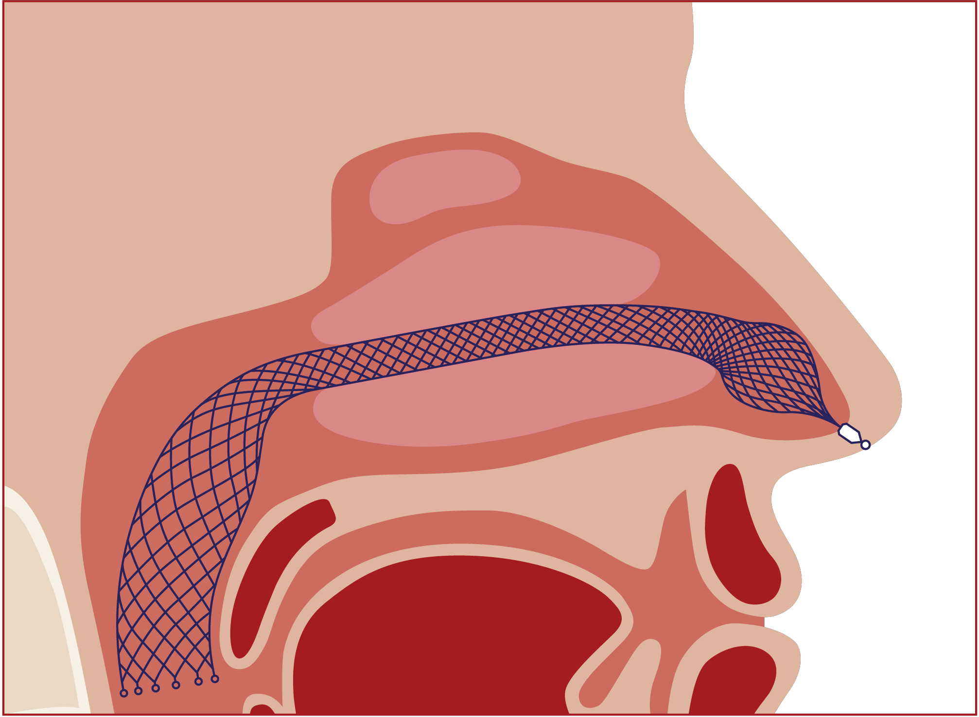 Alaxo Hybrid Stent